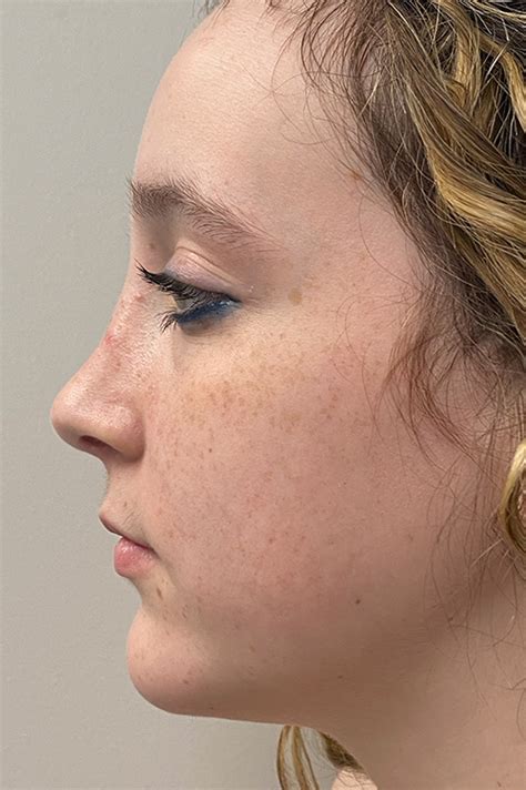 Los Angeles Rhinoplasty Before & After Photos Patient 14 | Dr. Aminpour