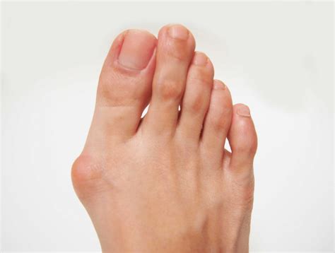 Difference Between A Corn, A Callus and a Bunion - Sydney Foot ...
