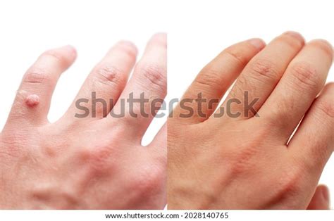 140 Before After Warts Images, Stock Photos & Vectors | Shutterstock