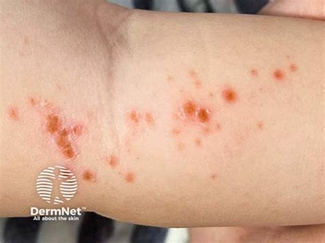 Hand, Foot, and Mouth Disease Images — DermNet