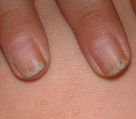 Hyperkeratosis Nails