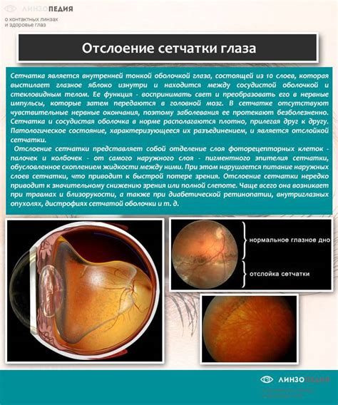 Деструкция стекловидного тела глаза: методы диагностики и лечение