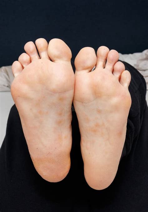 Dyshidrotic Eczema on the Sole of Female Feet Stock Image - Image of ...