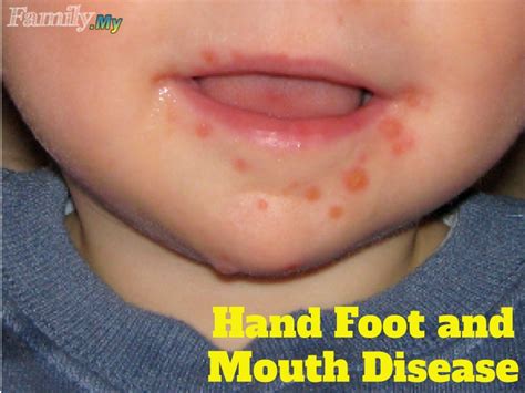 Can Adults Get Hand Foot And Mouth Disease Treatment at Jason Boyce blog