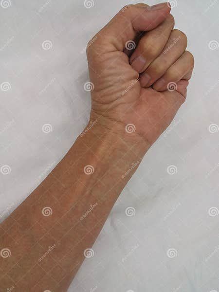 Red Rash on Arms Caused by Allergies Stock Image - Image of brown ...