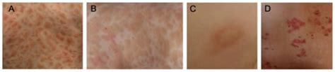 IJMS | Free Full-Text | Molecular Background, Clinical Features and ...