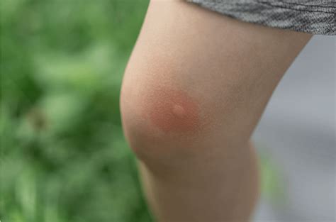 Alergia A Picadas De Insetos - Tipos de alergia: Conheça os mais comuns - Bem Estar Hospitalar