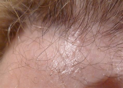 Frontal Fibrosing Alopecia