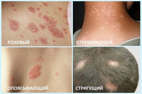 Лишай: описание, виды, причины появления лишая, диагностика и лечение в ...
