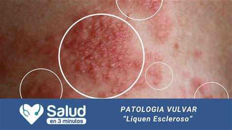 patologias vulvares liquen escleroso youtube