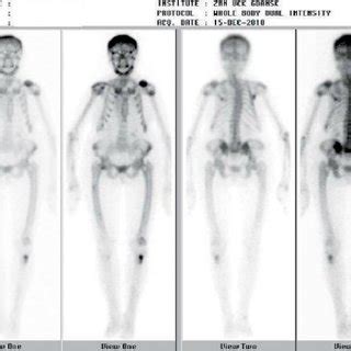 Increased 99mTc-MDP focal uptake in left clavicle, left tibia, right ...