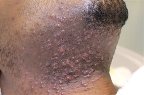 folliculitis barbae omschrijving laserkliniek