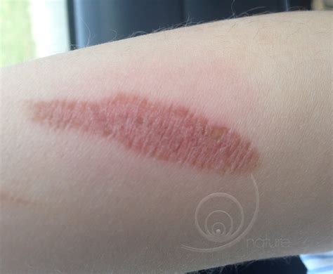 treatment effects category burn wound  clicking   picture