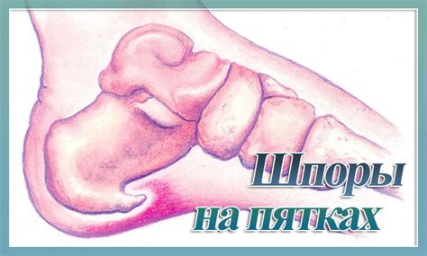 Шпоры на ногах лечение в домашних условиях, как выглядит, фото