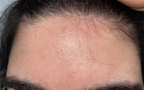 Are these comedones ? : r/skin