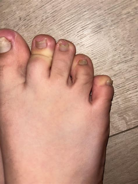 Terbinafine Course : r/NailFungus