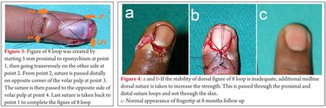 Finger tip injury; nail bed laceration; partial nail plate avulsion ...