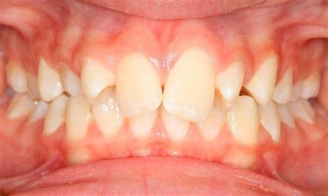 rotated teeth  marc beals blog