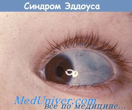Синдром синих склер - синонимы, авторы, клиника