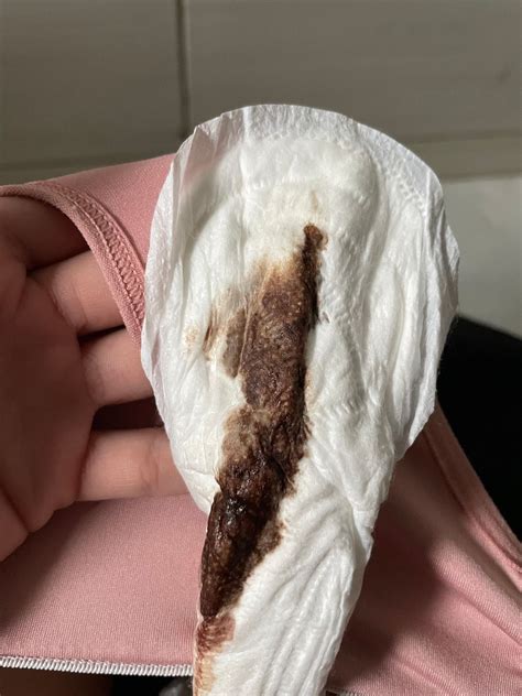 Menstruação Atrasada E Corrimento Marrom - Corrimento marrom e menstruação atrasadasa | BabyCenter