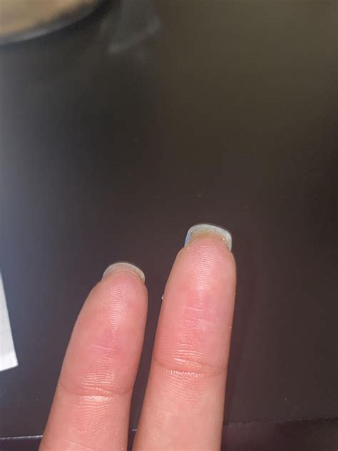 Overgrown, hard, kinda painful hyponychium. Help🥺🥺 [description in