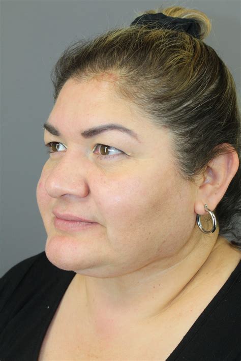 months  neck surgery     dr leo lapuerta