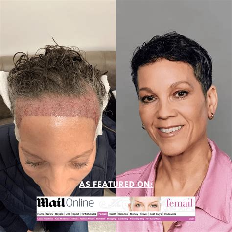 Receding Hairline Before And After