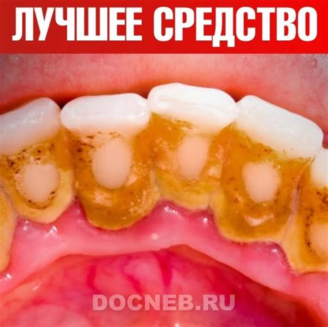 Зубной налет и зубной камень? Лучшее средство! — Dr. Berg ...
