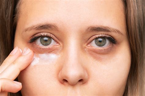 sunken eyes enophthalmos  treatment remedies faq