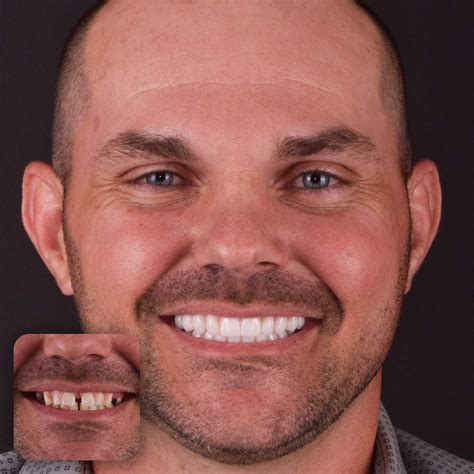 Doctors Implants – Full Mouth Dental Implants