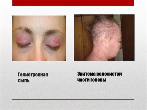 Идиопатические воспалительные миопатии: клиника, диагностика и лечение ...