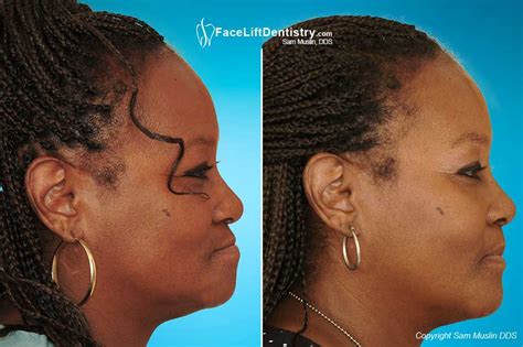 Facelift Dentures | The Advantages of Facelift Dentures