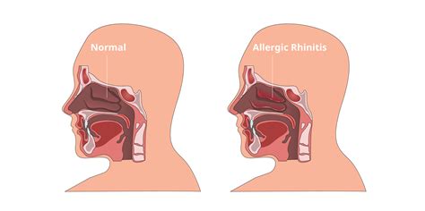 Rhinitis - Allergic : Initial Assessment | MIMS Indonesia