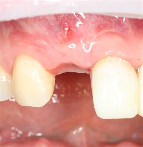 Куда уходит костный блок? — IMPLANT-IN.COM — дентальная имплантация ...