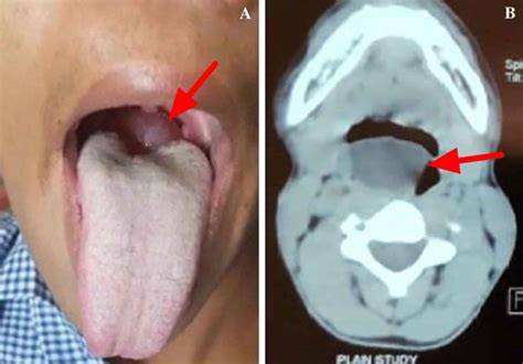 epiglottic cyst symptoms