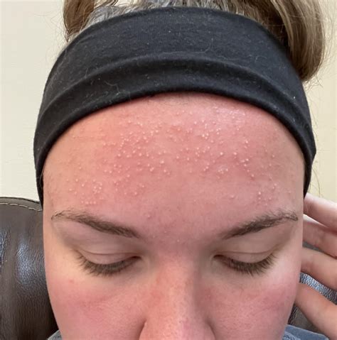 sunburn on face treatment 4