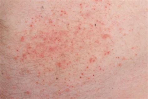 dermatitis herpetiformis legs pictures   rash dermatitis