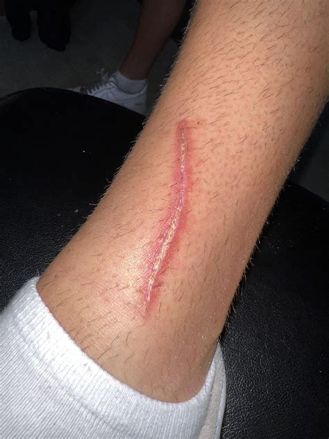 Cut my leg last week should I do anything? : r/AskDoctorSmeeee