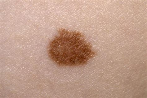 Skin Cancer Cells All You Should Understand About Non Melanoma Skin ...