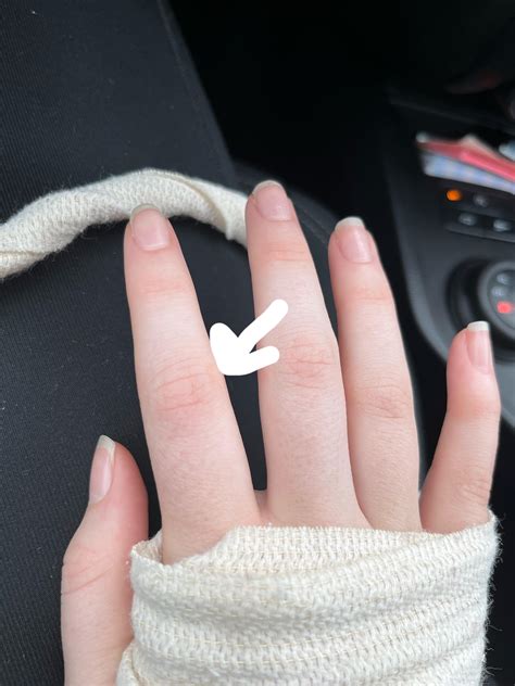 Sprained Finger?? : r/medical_advice