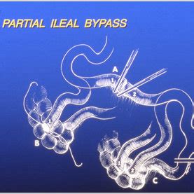 partial ileal bypass  division  ileum  cm   ileocecal