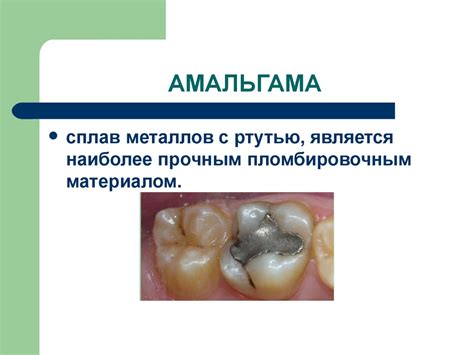 Пломбировочный материал амальгама в зубоврачевании - презентация онлайн
