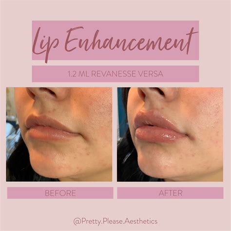 Lip filler before and after | Lip fillers, Facial aesthetics, Natural lips