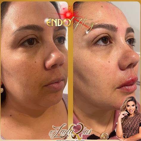 Endolift Antes E Depois - Endolift Antes E Depois Abdomen - RETOEDU