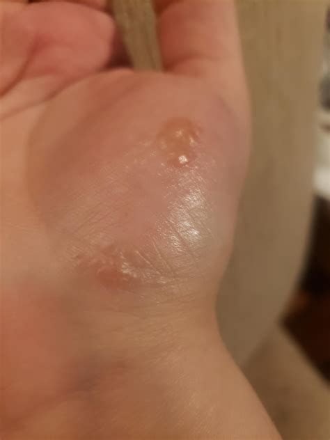 Are these warts? I have no health insurance to get these checked out