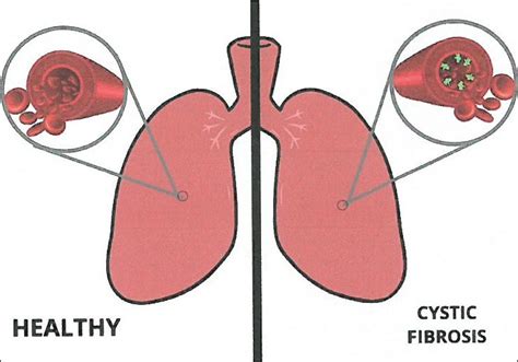 cystic fibrosis uniscience publishers
