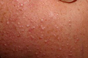 Milia: Small White Bumps | U.S. Dermatology Partners