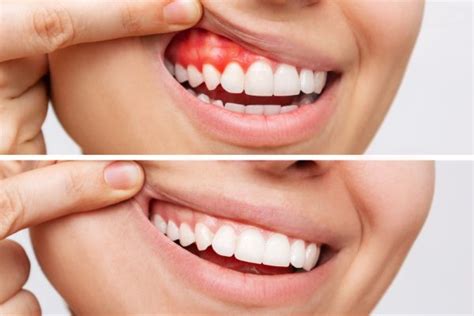 Stages of Gum Disease | Seattle Dentist Near You