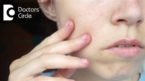What Is Dyshidrotic Eczema Youtube - vrogue.co