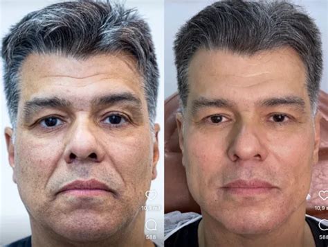 Stênio Garcia Antes E Depois - Aos 91 anos, Stênio Garcia é a pessoa mais velha a fazer harmonização ...